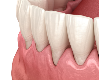 gum recession and tissue grafting